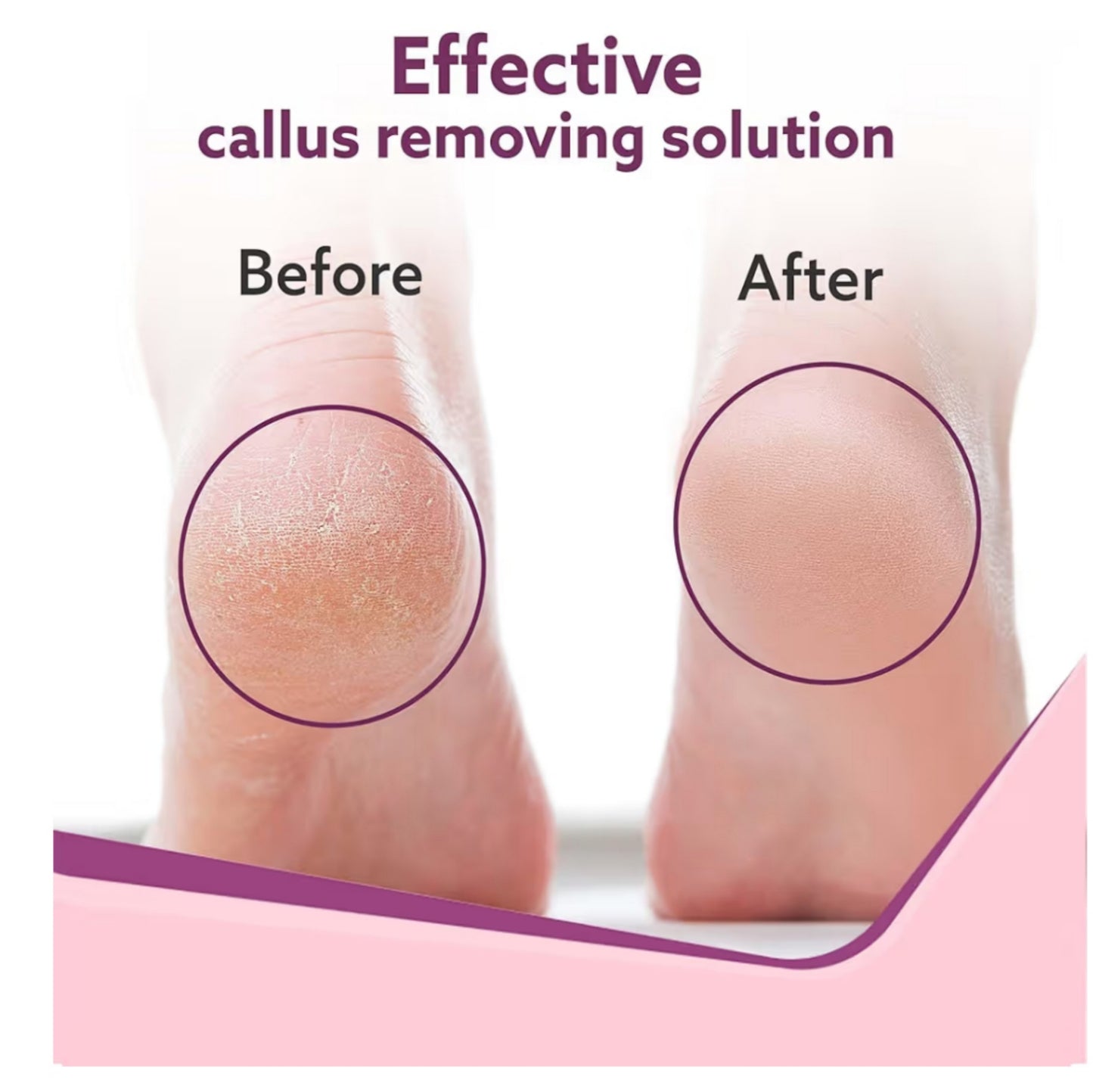 Foot Roller Callus Remover Hard and Dead Skin Remover